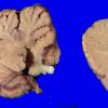 2H2 Wolfram Syndrome (Case 2) _13