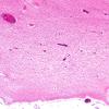 3B3 Wolfram Syndrome (Case 3) N4 4X