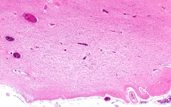 3B3 Wolfram Syndrome (Case 3) N4 4X