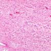 3B4 Wolfram Syndrome (Case 3) N4 10X