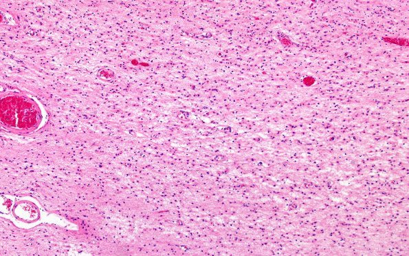 3B4 Wolfram Syndrome (Case 3) N4 10X