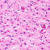 3B5 Wolfram Syndrome (Case 3) N4 40X