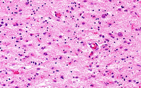 3B5 Wolfram Syndrome (Case 3) N4 40X