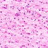3B6 Wolfram Syndrome (Case 3) N4 LGN 40X