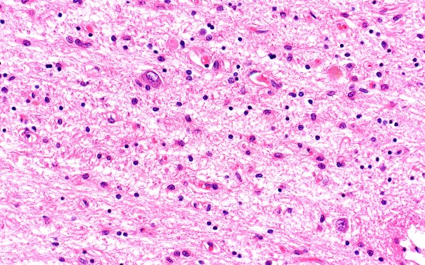 3B6 Wolfram Syndrome (Case 3) N4 LGN 40X