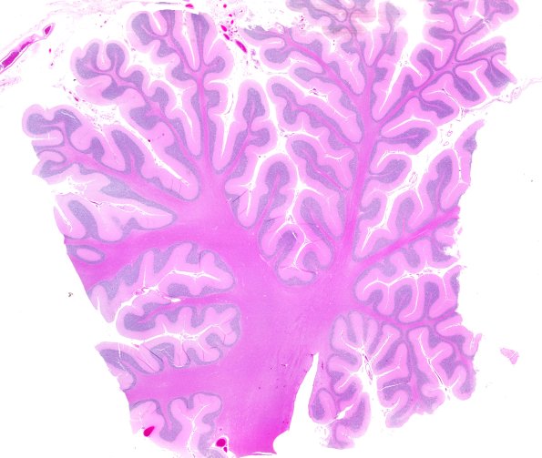 3D1 Wolfram Syndrome (Case 3) N3 WM