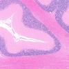 3D2 Wolfram Syndrome (Case 3) N13 4X