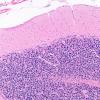 3D3 Wolfram Syndrome (Case 3) N13 10X