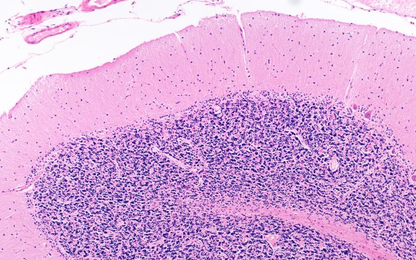 3D3 Wolfram Syndrome (Case 3) N13 10X