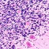 3D4 Wolfram Syndrome (Case 3) N9 40X