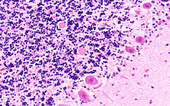 3D4 Wolfram Syndrome (Case 3) N9 40X