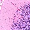 3D5 Wolfram Syndrome (Case 3) N13 20X