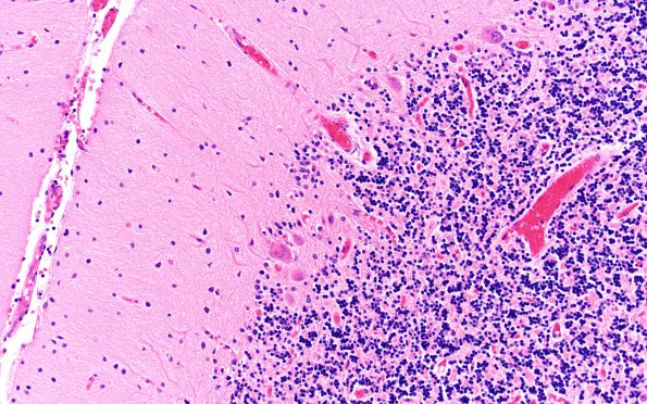 3D5 Wolfram Syndrome (Case 3) N13 20X
