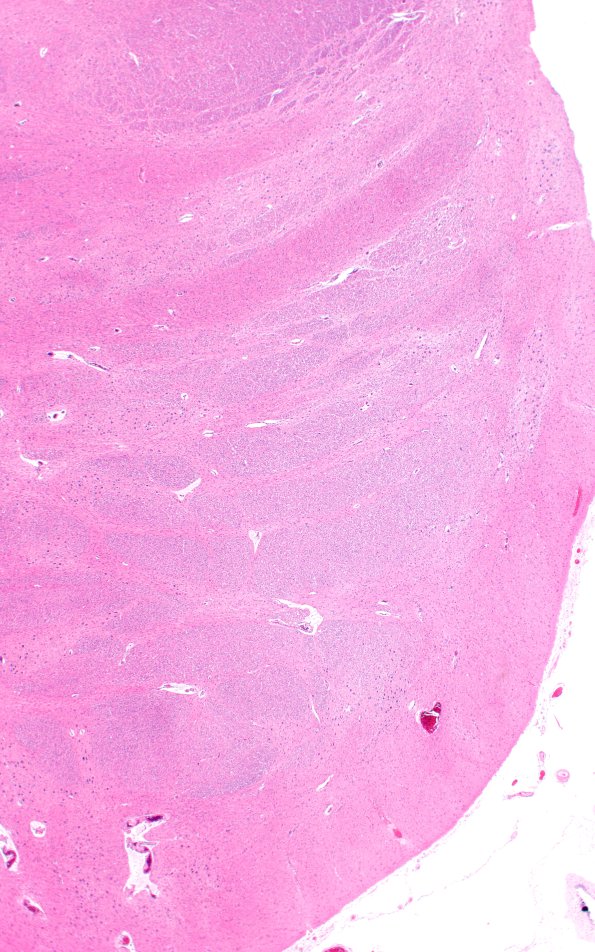 3F2 Wolfram Syndrome (Case 3) N7 2X