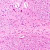 3F4 Wolfram Syndrome (Case 3) N7 20X