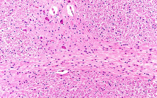3F4 Wolfram Syndrome (Case 3) N7 20X