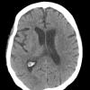 1A1 Xanthogranulomas (Case 1) CT Contrast CRI 3 - Copy