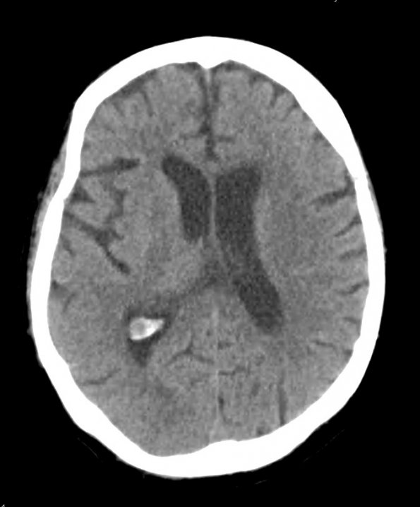 1A1 Xanthogranulomas (Case 1) CT Contrast CRI 3 - Copy