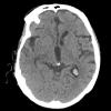 1A2 Xanthogranulomas (Case 1) CT 2 - Copy