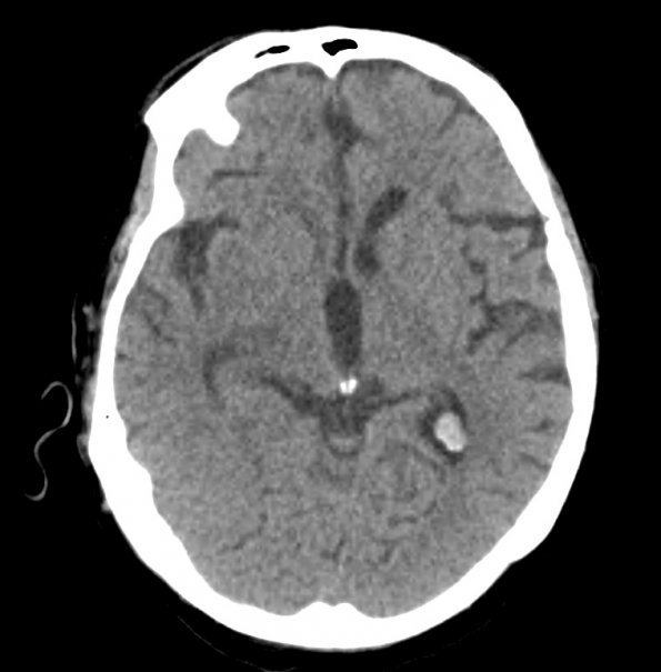 1A2 Xanthogranulomas (Case 1) CT 2 - Copy