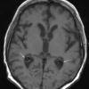 1A3 Xanthogranulomas (Case 1) T1 SE copy - Copy