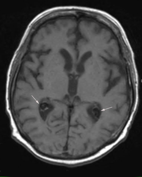 1A3 Xanthogranulomas (Case 1) T1 SE copy - Copy