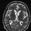 1A4 Xanthogranulomas (Case 1) T2 SE copy - Copy