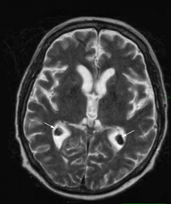 1A4 Xanthogranulomas (Case 1) T2 SE copy - Copy