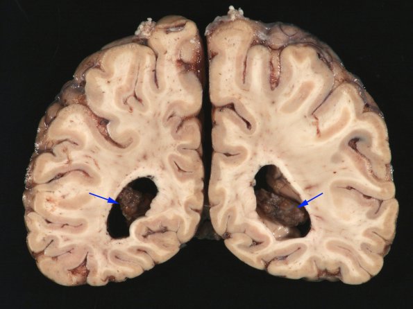 1B1 Xanthogranuloma, choroid plexus (Case 1) Gross_5 copy