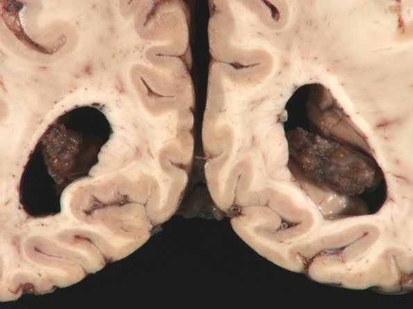 1B2 Xanthogranuloma, choroid plexuses (Case 1) Gross_6