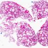 1C1 Xanthogranulomas (Case 1) H&E whole mount copy