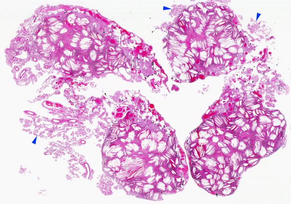 1C1 Xanthogranulomas (Case 1) H&E whole mount copy