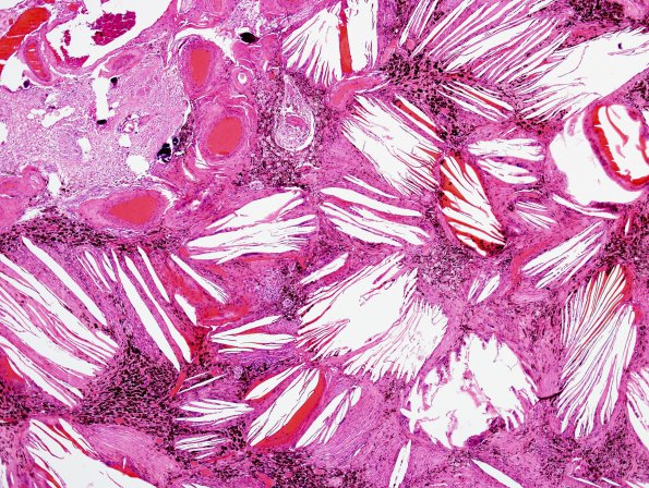 1C3 Xanthogranulomas (Case 1) H&E 4