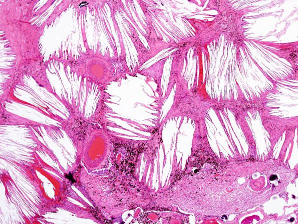 1C4 Xanthogranulomas (Case 1) H&E 3