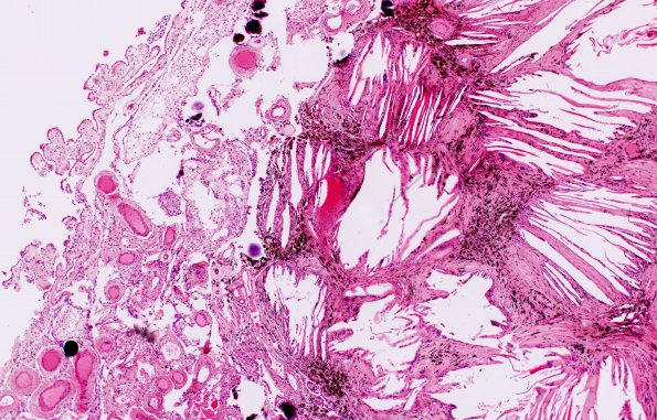 1C5 Xanthogranulomas (Case 1) H&E 8