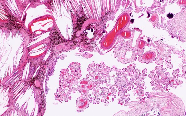 1C6 Xanthogranulomas (Case 1) H&E 13