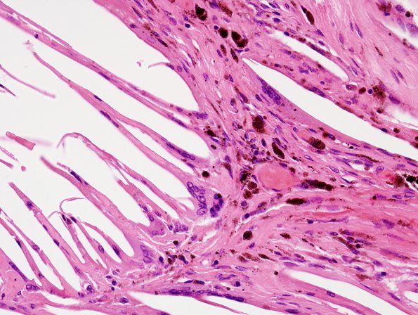 1C7 Xanthogranulomas (Case 1) H&E 1