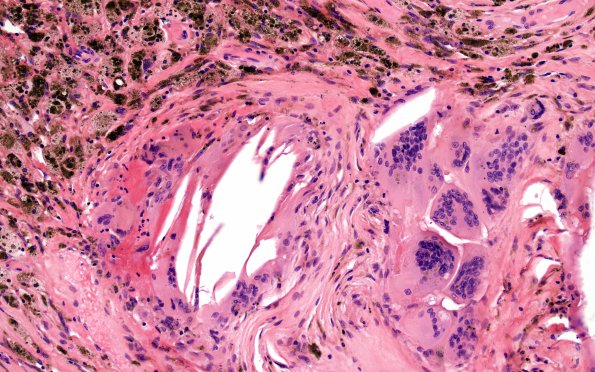 1C8 Xanthogranulomas (Case 1) H&E 9