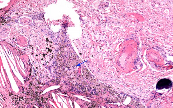 1C9 Xanthogranulomas (Case 1) H&E 5 copy