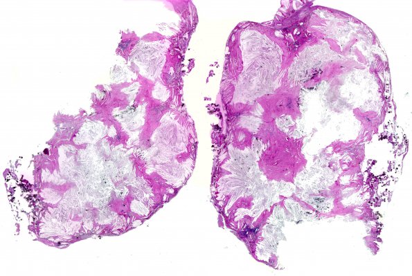 2A1 Xanthogranuloma of CP (Case 2) H&E 1