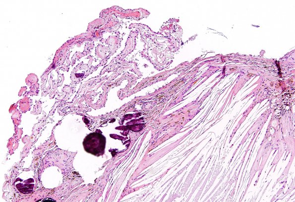 2A3 Xanthogranuloma of CP (Case 2) H&E 3