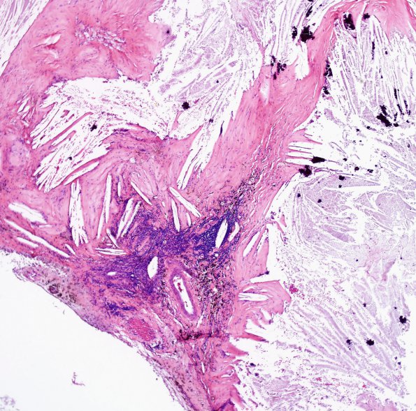 2A4 Xanthogranuloma of CP (Case 2) H&E 6