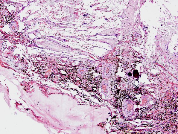 2A5 Xanthogranuloma of CP (Case 2) H&E 13