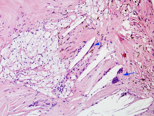 2A7 Xanthogranuloma of CP (Case 2) H&E 8 copy