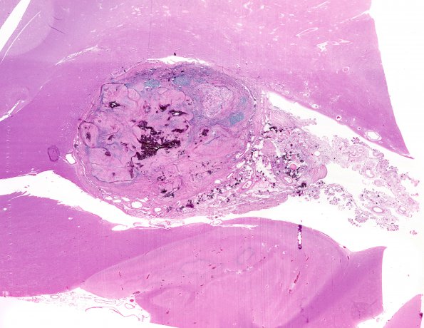 3A1 Xanthogranuloma (Case 3) H&E whole mount