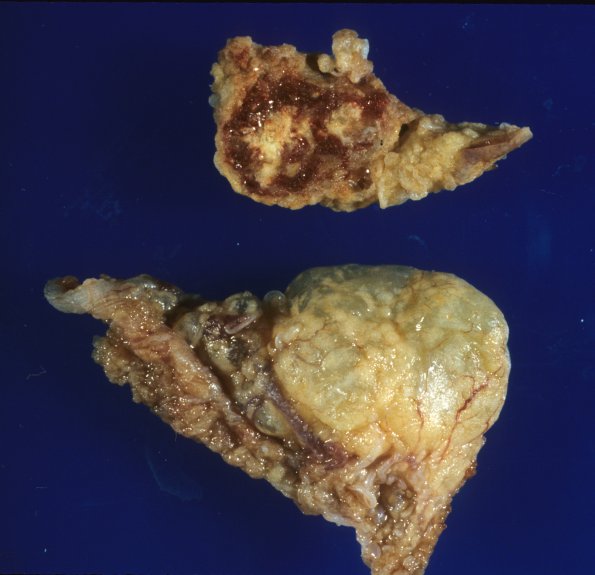 5A1 Xanthogranuloma, choroid plexus (Case 5)