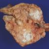 5A2 Xanthogranuloma, choroid plexus (Case 5) 2