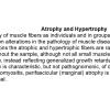 0A Atrophy - Text