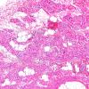 10A1-Spinal-Muscular-Atrophy-Case-10-H-E-1.jpg