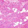 10A2-Spinal-Muscular-Atrophy-Case-10-H-E-2.jpg